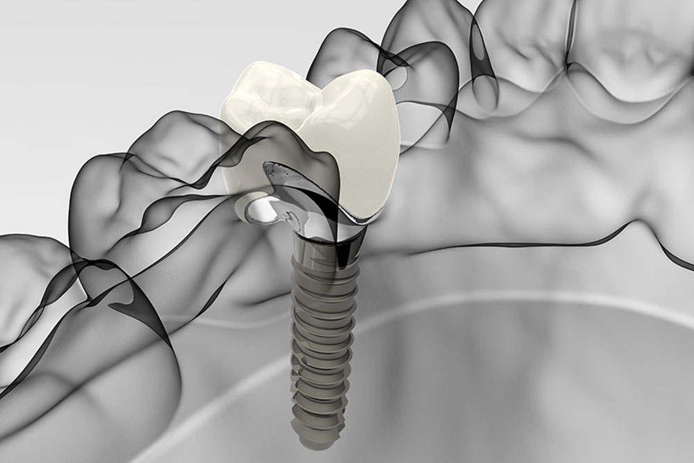Diagonal Dent - Implantes dentales